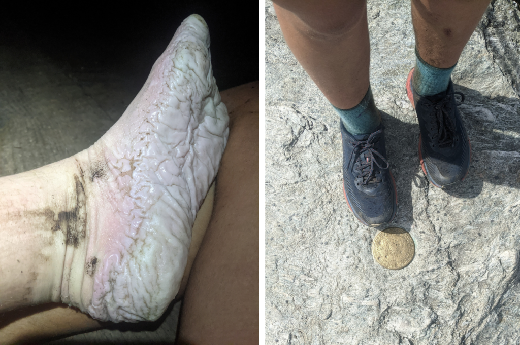 Trench foot (left) vs healthy feet in shoes (right); courtesy, Mikaela Osler